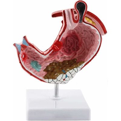 Model ulcer gastric